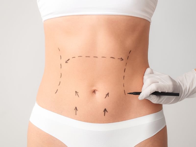 cómo recuperarte tras una abdominoplastia